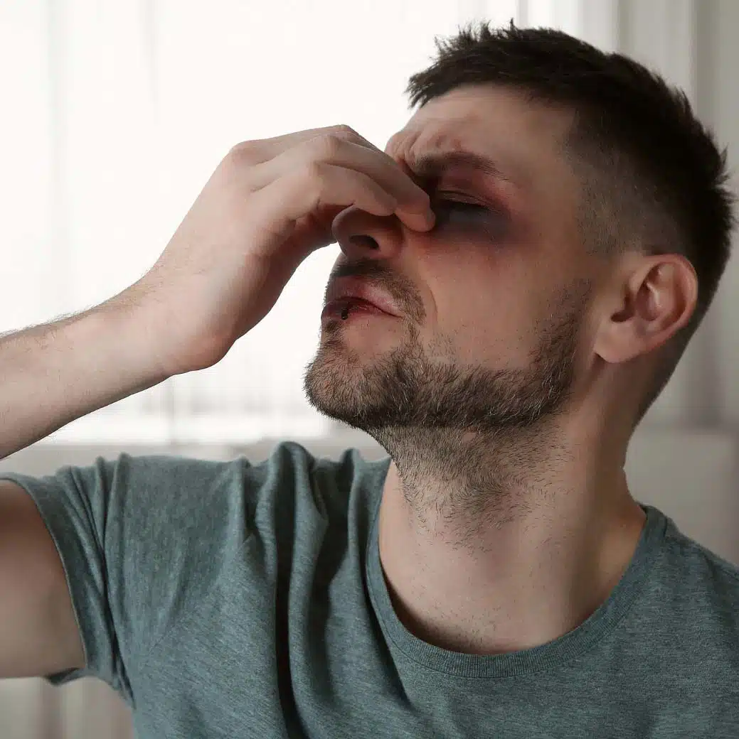 homme visage tuméfié victime d'une agression
